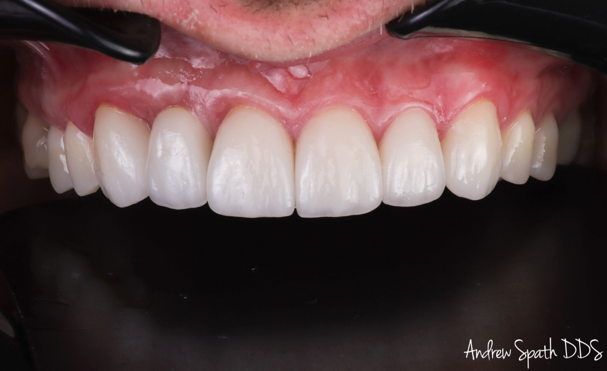 dental-implant-5-veneers-case-study-newport-beach-ca-1