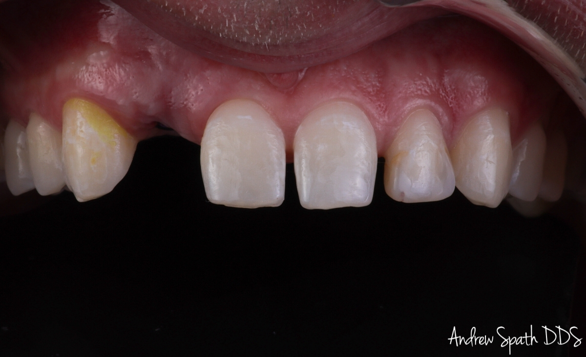 dental-implant-5-veneers-case-study-newport-beach-ca-3