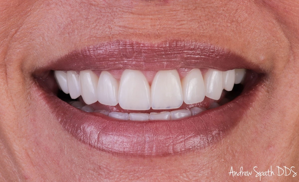 smile-design-cosmetic-dentistry-newport-beach-case-12