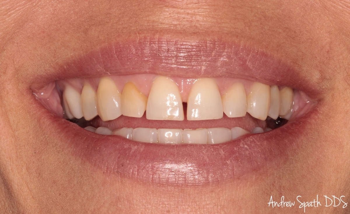 smile-design-cosmetic-dentistry-newport-beach-case-13