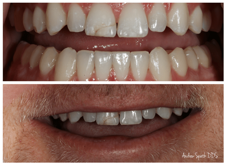 Pool Accident Leads to Bonding & Veneers - General & Cosmetic