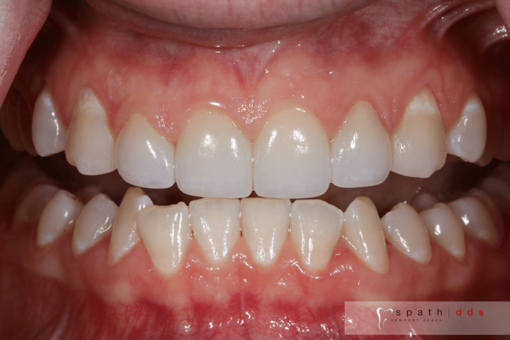 Invisalign Crown Lengthening Surgery And Veneers General And Cosmetic Dentist In Newport Beach