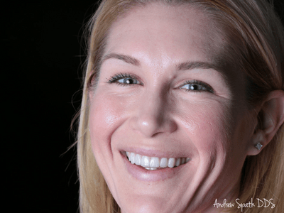 andrea-before-afters-dentist-in-newport-beach-ca-spath-dentistry-1