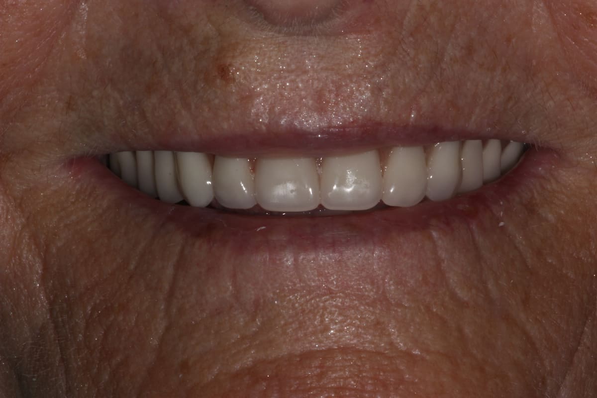 denture-after-smile-by-dr-andrew-spath-1200x800