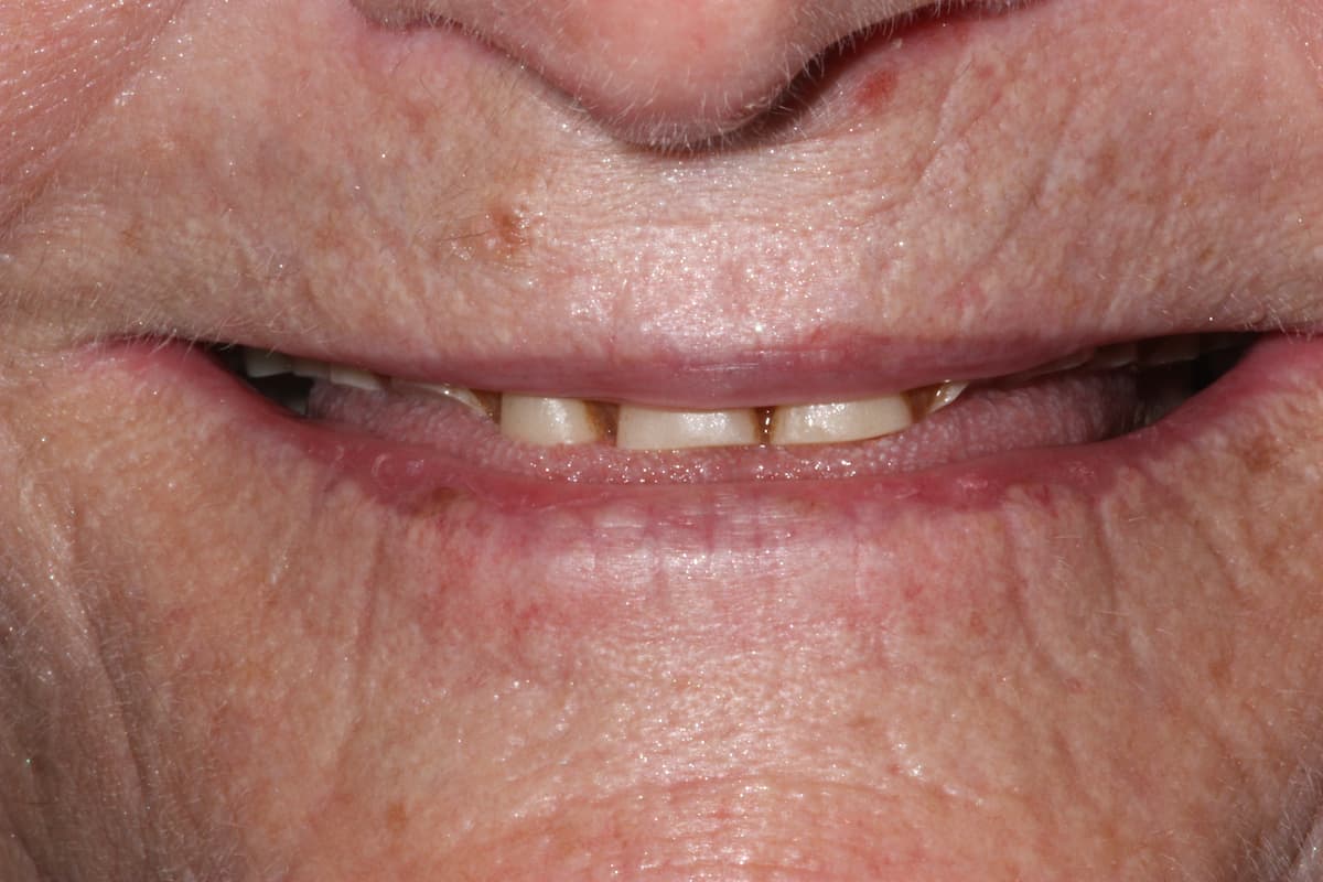 denture-before-smile-in-orange-ca-dentist-1200x800