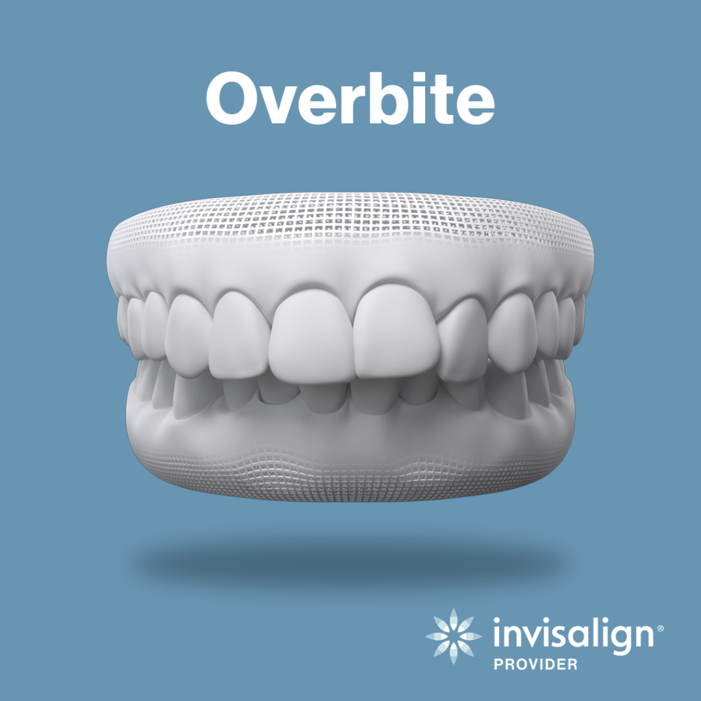 Can You Fix an Overbite With Invisalign®?