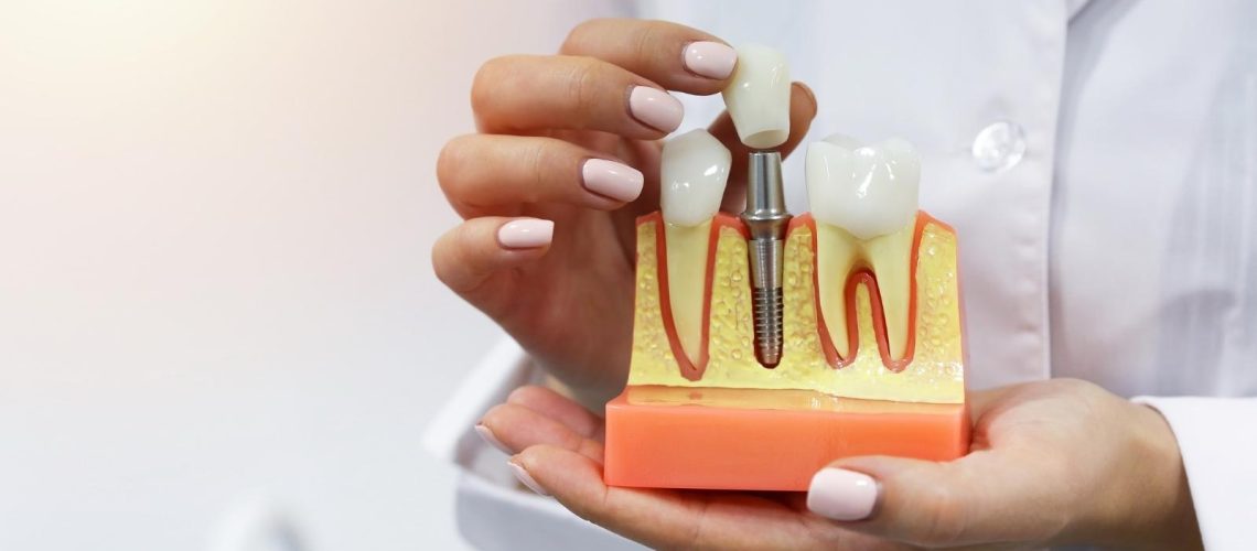 What_are_dental_implants